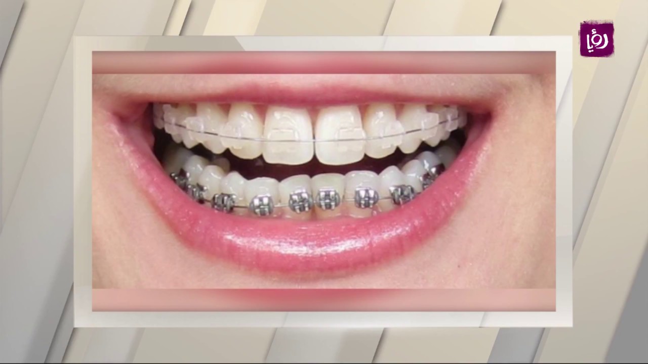 Interview with Dr. Samer Sunna with Ruya Channel – Orthodontics and Maxillofacials